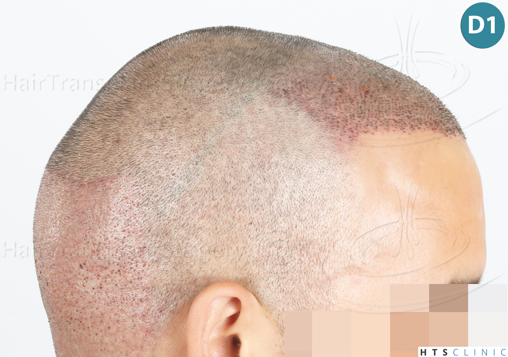 Dr.Devroye-Montesanti-Jenard-HTS-Clinic-2018-FUE-11.jpg