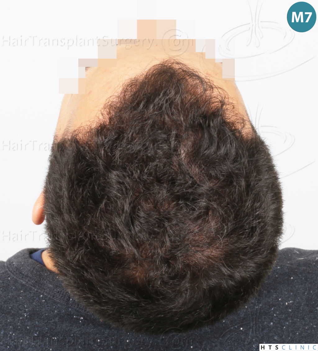 Dr.Devroye-Montesanti-Jenard-HTS-Clinic-2018-FUE-22.jpg