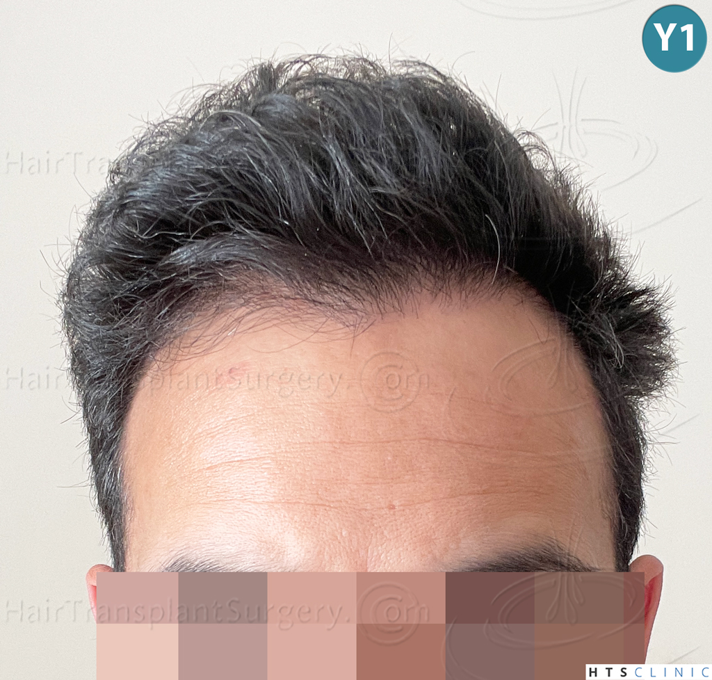Dr.Devroye-Montesanti-Jenard-HTS-Clinic-2018-FUE-23.jpg