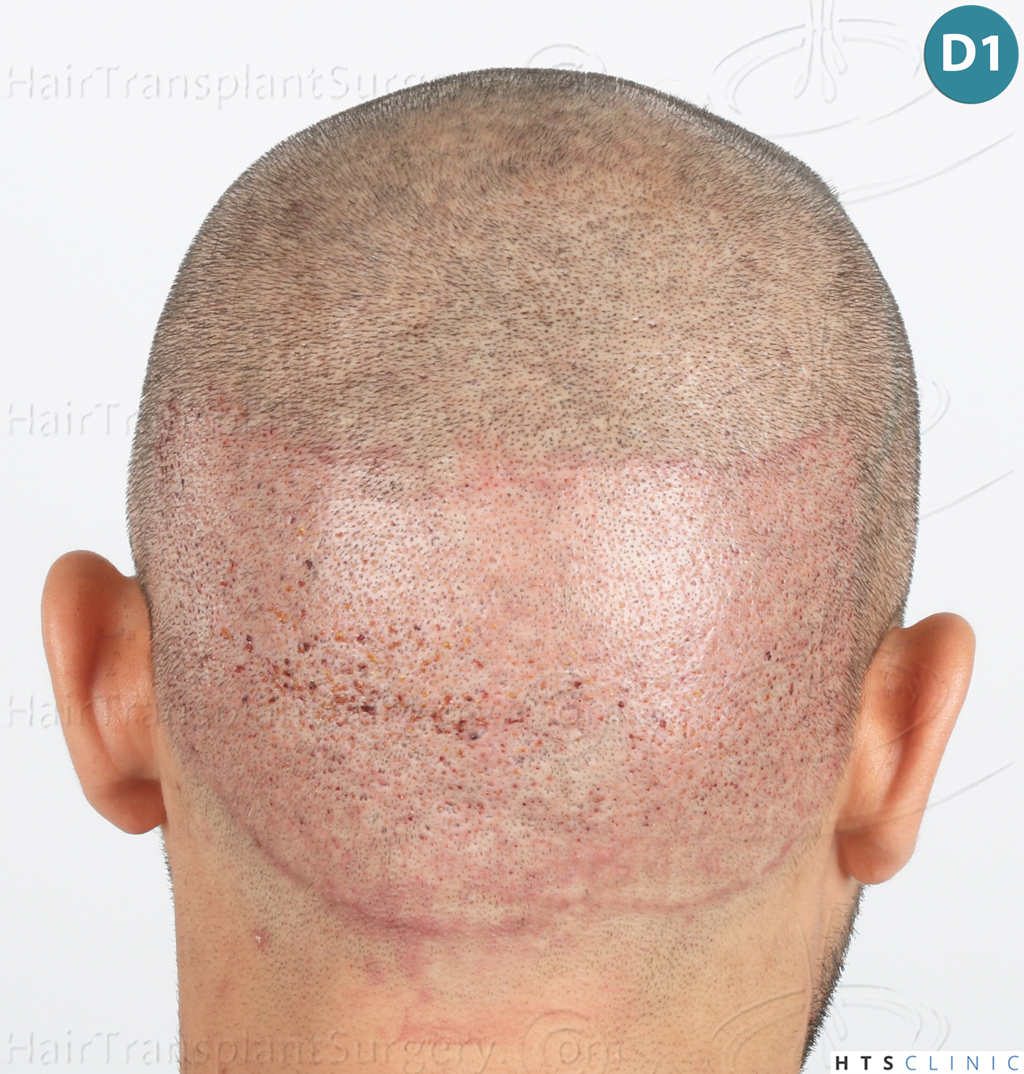 Dr.Devroye-Montesanti-Jenard-HTS-Clinic-2018-FUE-13.jpg