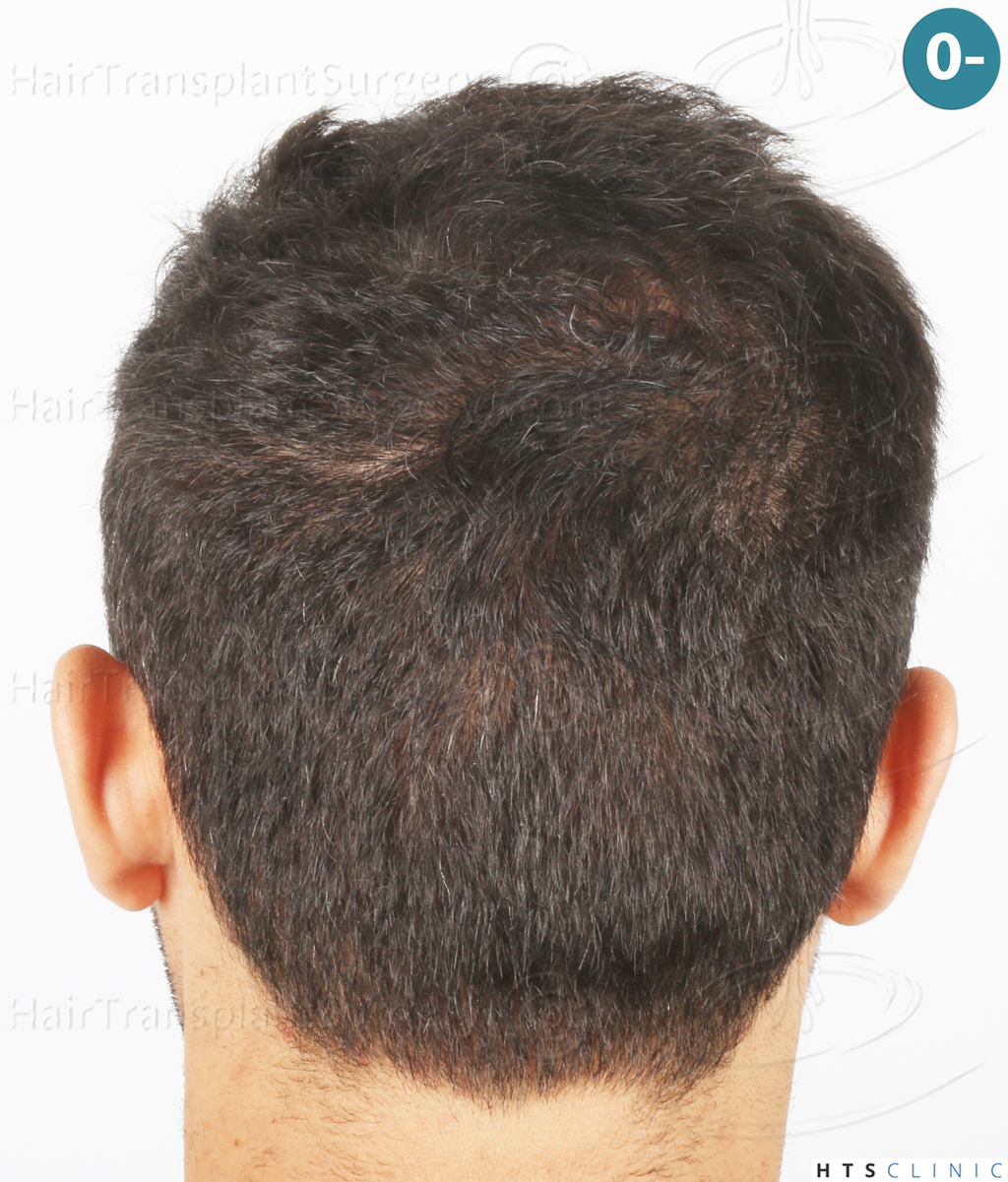 Dr.Devroye-Montesanti-Jenard-HTS-Clinic-2018-FUE-6.jpg