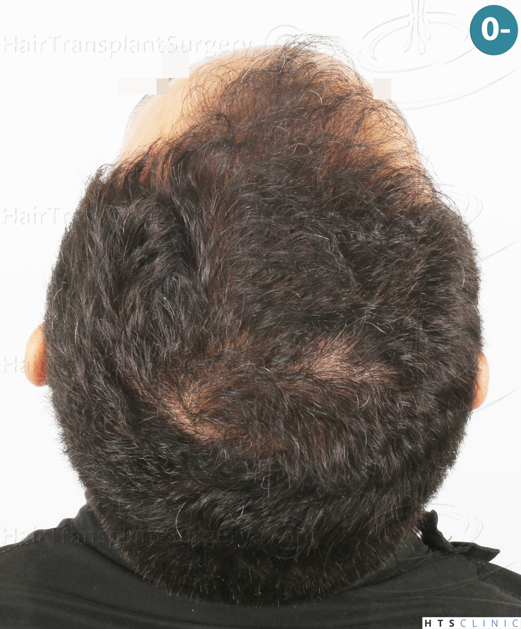 Dr.Devroye-Montesanti-Jenard-HTS-Clinic-2018-FUE-7.jpg