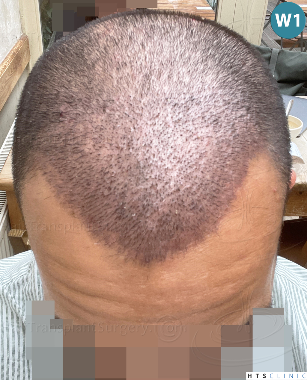 Dr.Devroye-Montesanti-Jenard-HTS-Clinic-2018-FUE-14.jpg