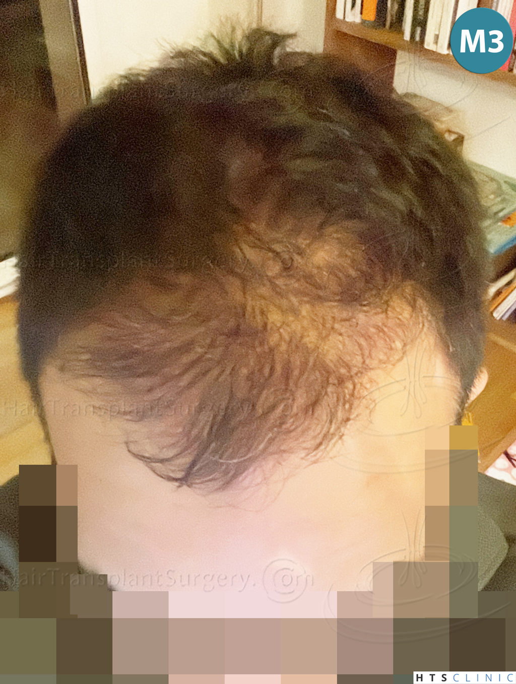 Dr.Devroye-Montesanti-Jenard-HTS-Clinic-2018-FUE-16.jpg
