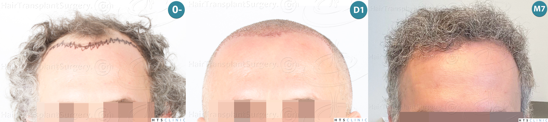 Dr.Devroye-Montesanti-Jenard-HTS-Clinic-2932-FUE-Montage1.jpg
