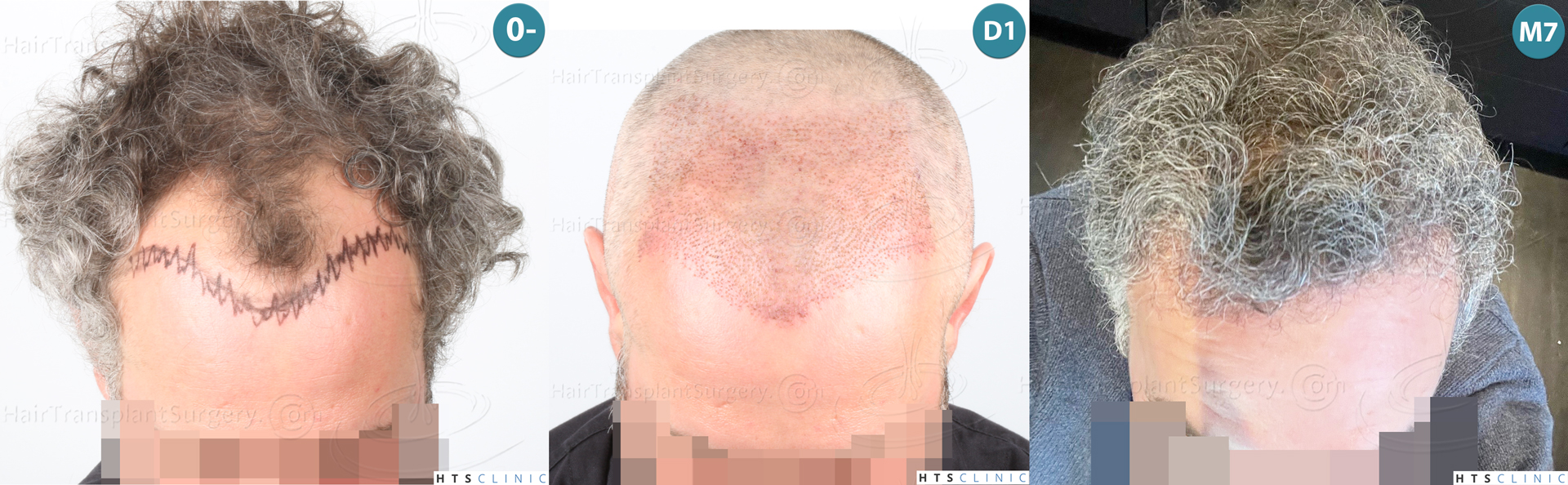 Dr.Devroye-Montesanti-Jenard-HTS-Clinic-2932-FUE-Montage2.jpg