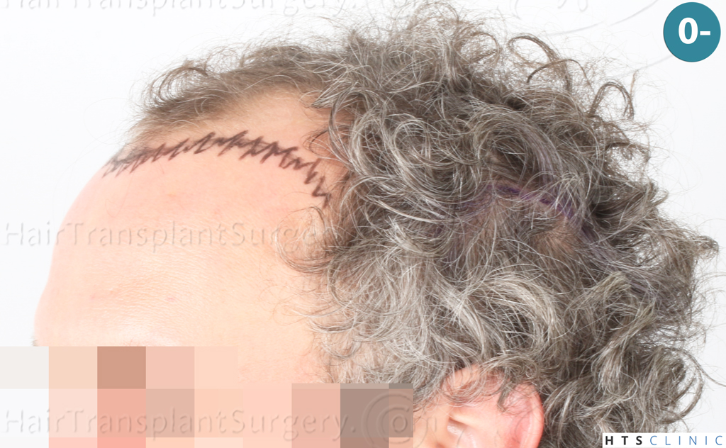 Dr.Devroye-Montesanti-Jenard-HTS-Clinic-2932-FUE-3.jpg