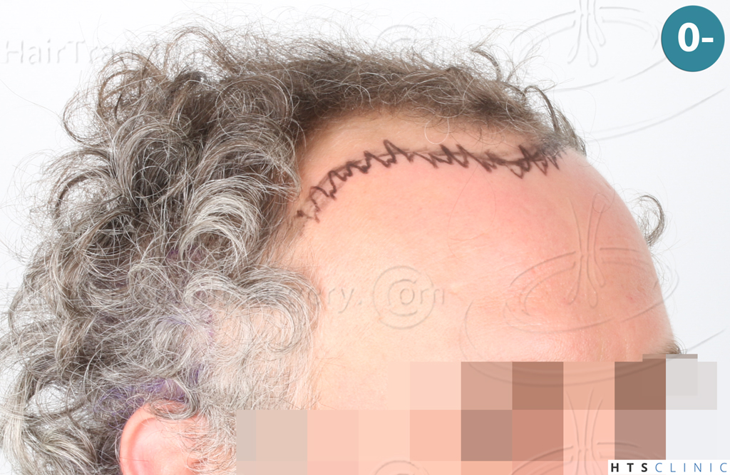Dr.Devroye-Montesanti-Jenard-HTS-Clinic-2932-FUE-4.jpg