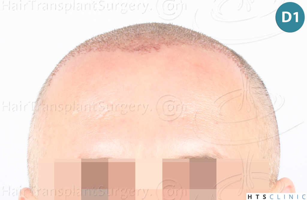 Dr.Devroye-Montesanti-Jenard-HTS-Clinic-2932-FUE-7.jpg