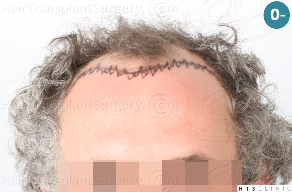 Dr.Devroye-Montesanti-Jenard-HTS-Clinic-2932-FUE-1.jpg