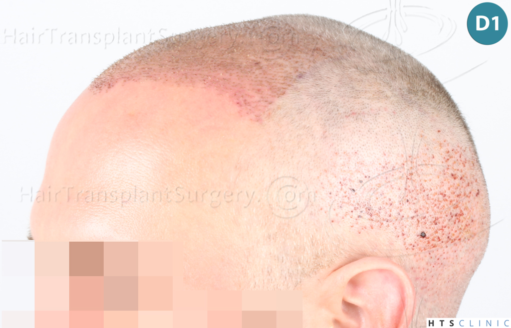 Dr.Devroye-Montesanti-Jenard-HTS-Clinic-2932-FUE-9.jpg