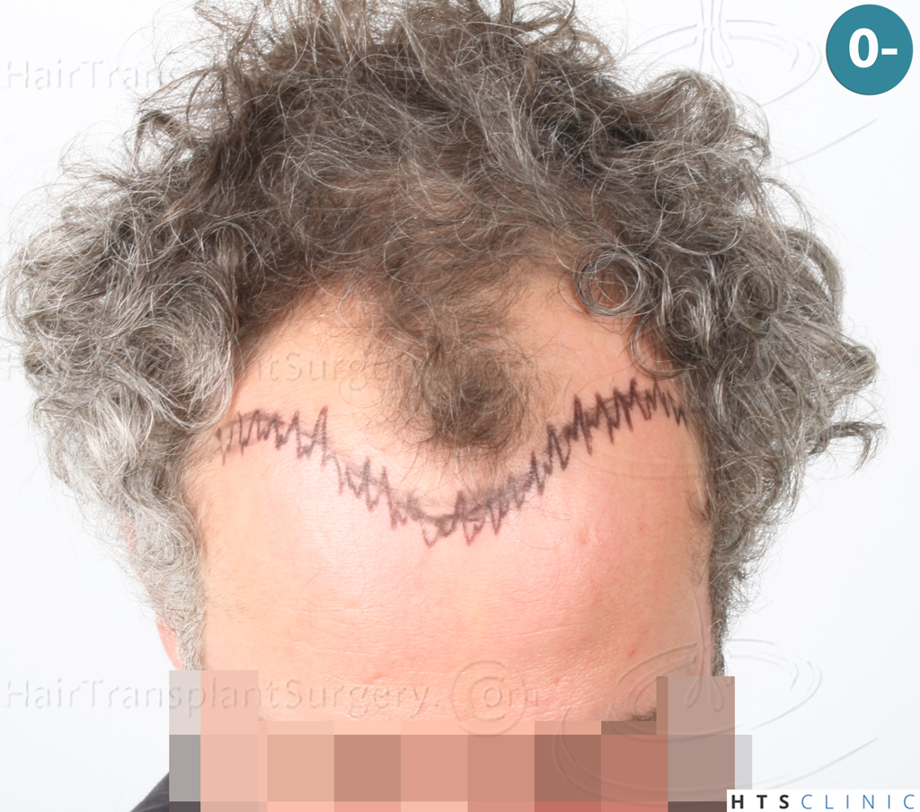 Dr.Devroye-Montesanti-Jenard-HTS-Clinic-2932-FUE-2.jpg