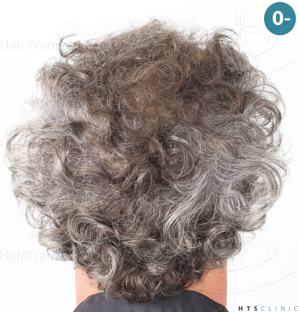 Dr.Devroye-Montesanti-Jenard-HTS-Clinic-2932-FUE-5.jpg