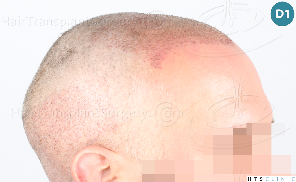 Dr.Devroye-Montesanti-Jenard-HTS-Clinic-2932-FUE-10.jpg