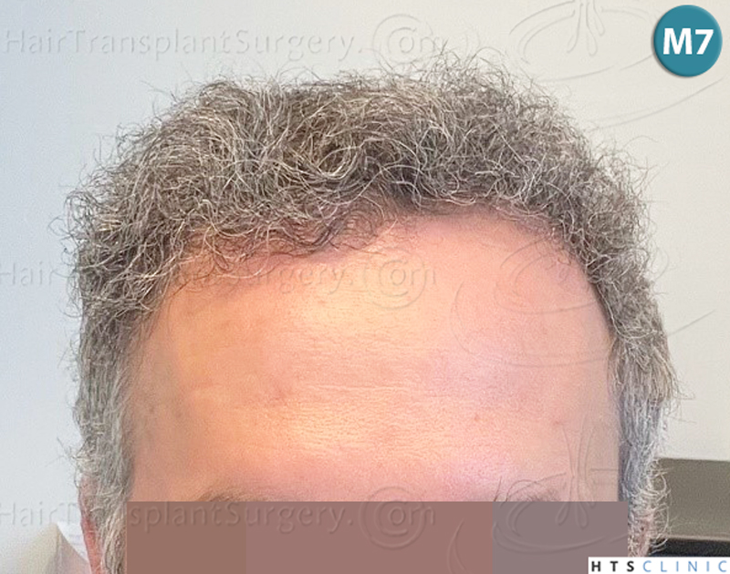 Dr.Devroye-Montesanti-Jenard-HTS-Clinic-2932-FUE-13.jpg