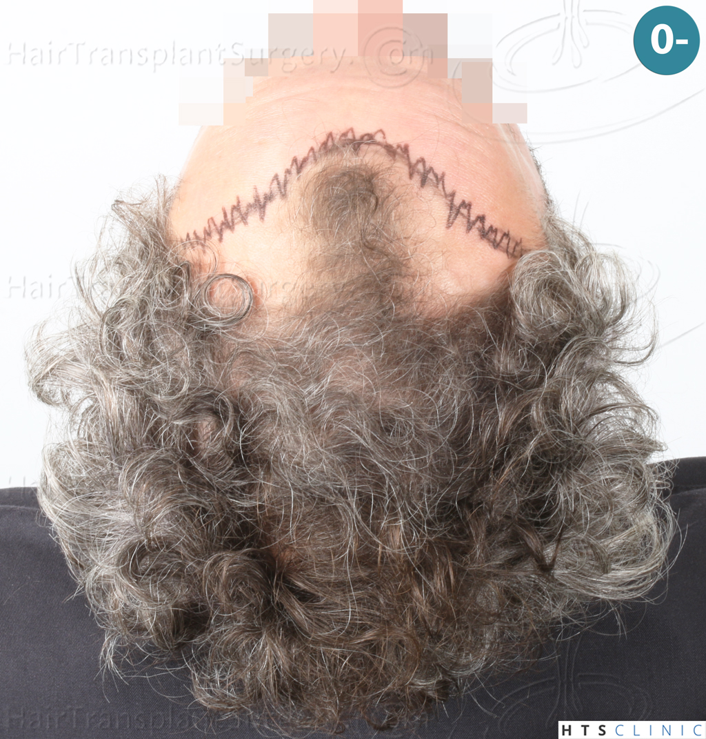 Dr.Devroye-Montesanti-Jenard-HTS-Clinic-2932-FUE-6.jpg