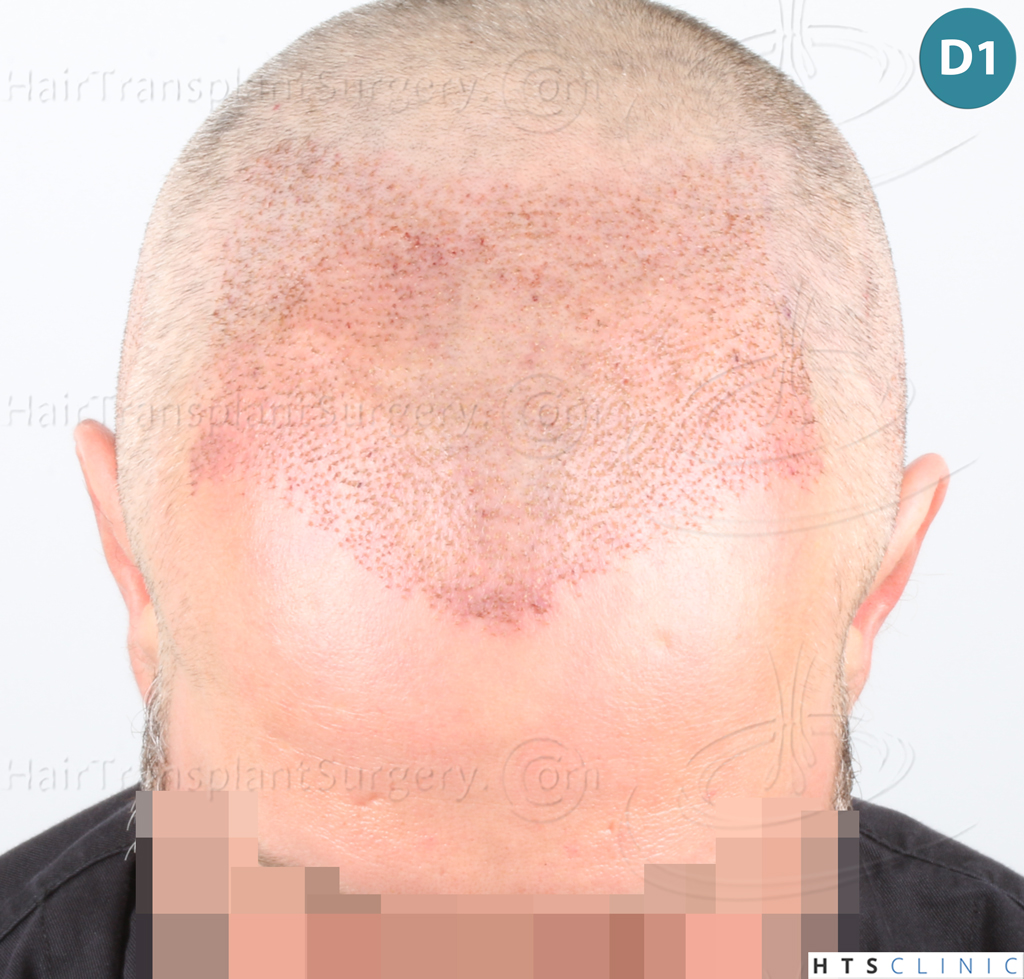 Dr.Devroye-Montesanti-Jenard-HTS-Clinic-2932-FUE-8.jpg