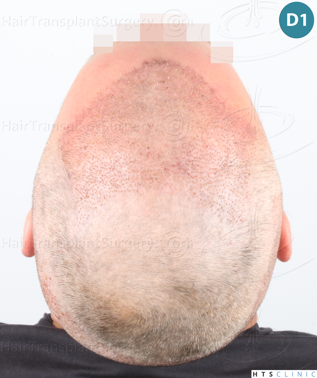 Dr.Devroye-Montesanti-Jenard-HTS-Clinic-2932-FUE-12.jpg