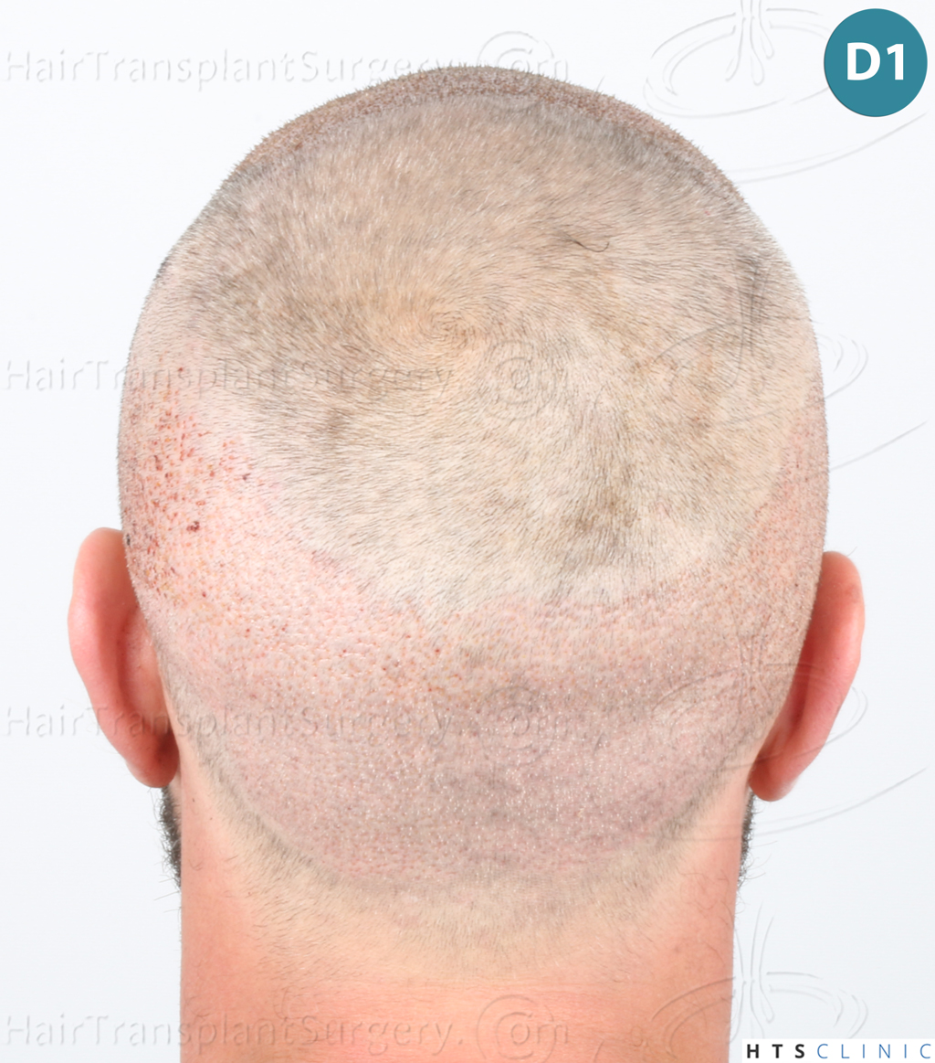 Dr.Devroye-Montesanti-Jenard-HTS-Clinic-2932-FUE-11.jpg