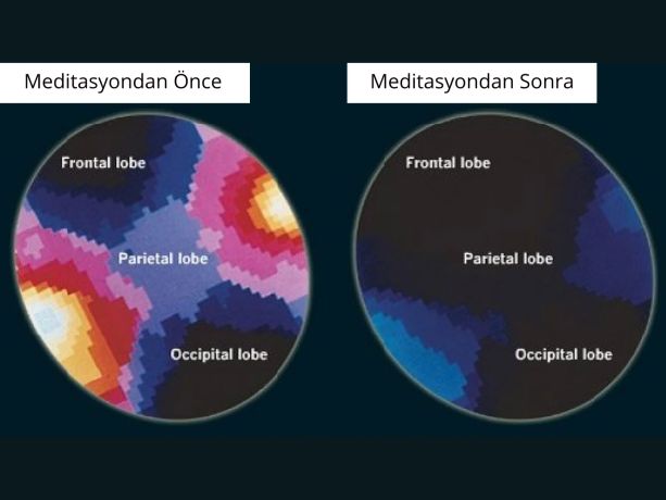 Meditasyon sırasında, beynin aktif düşüncelerden uzaklaşıp daha sakin bir duruma geçtiği ve bu durumun beta dalga aktivitesinde belirgin bir azalmaya yol açtığı görülmektedir.