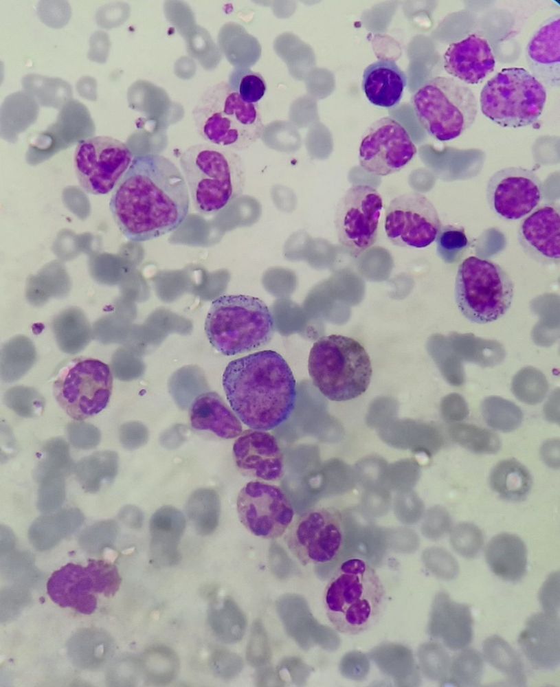 Chronic Myeloid Leukemia