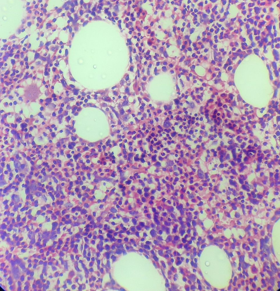 Iron Deficiency Anemia howitreat.in