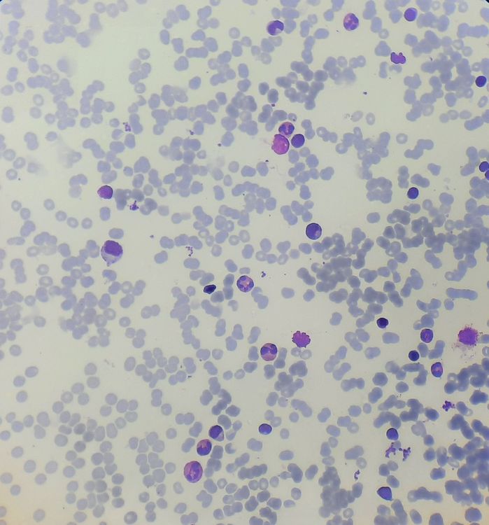 Pure Red Cell Aplasia howitreat.in