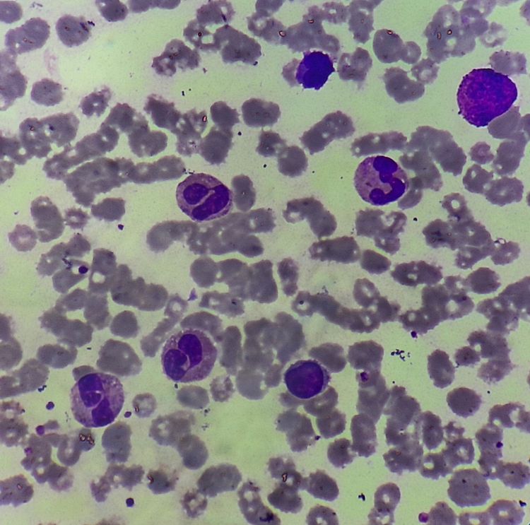 Chronic Eosinophilic Leukemia