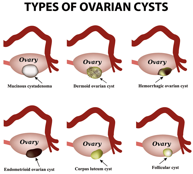 Ovarian Cysts  Types  Causes  Symptoms And Treatment