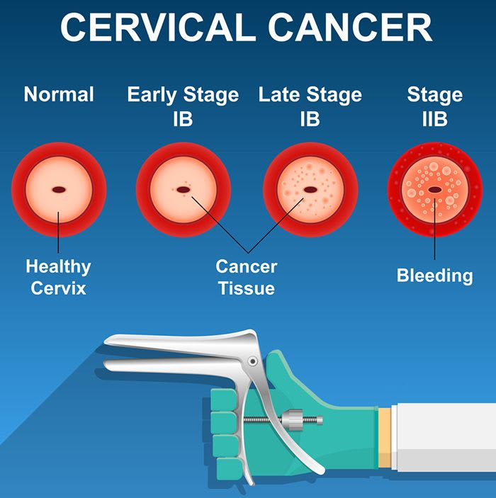 Pap smear age Pap smear age picture