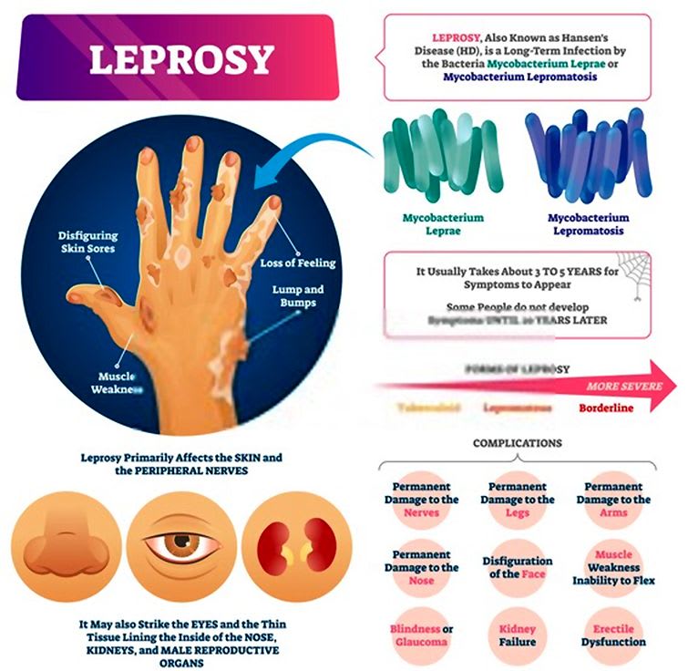 Leprosy (Hansen’s Disease): Causes, Symptoms, Diagnosis, Treatment And