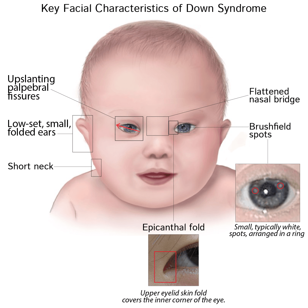Down's Syndrome: Let's Learn More About The Causes, Symptoms, Diagnosis And Treatment
