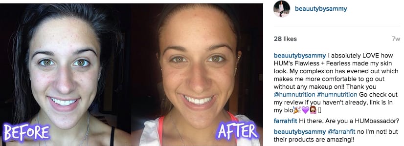 Sammy's skin Before & After with HUM's Flawless + Fearless - The Wellnest by HUM Nutrition