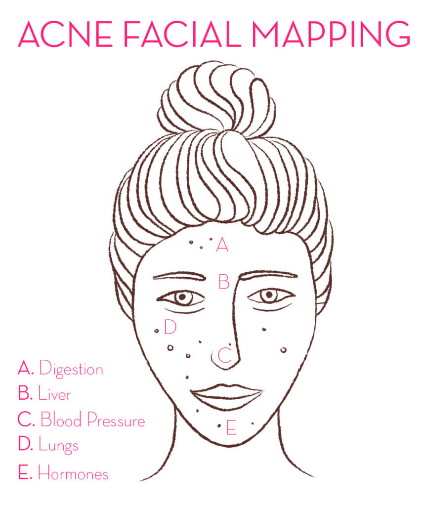 Acne Face Chart Meaning