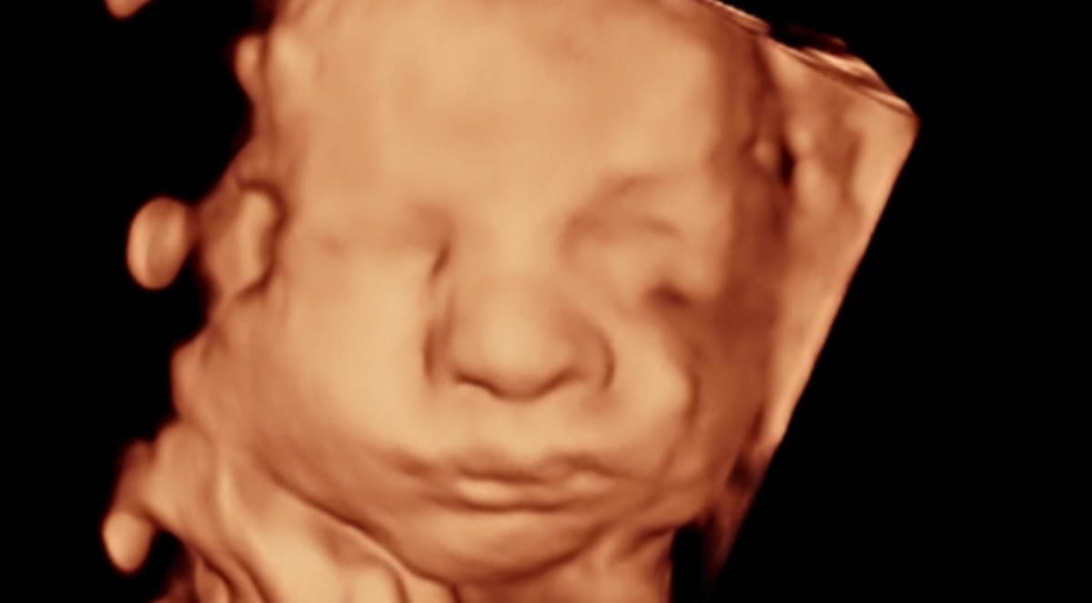A 3D ultrasound image displays a baby's face in the foreground against a dark, indistinct background.
