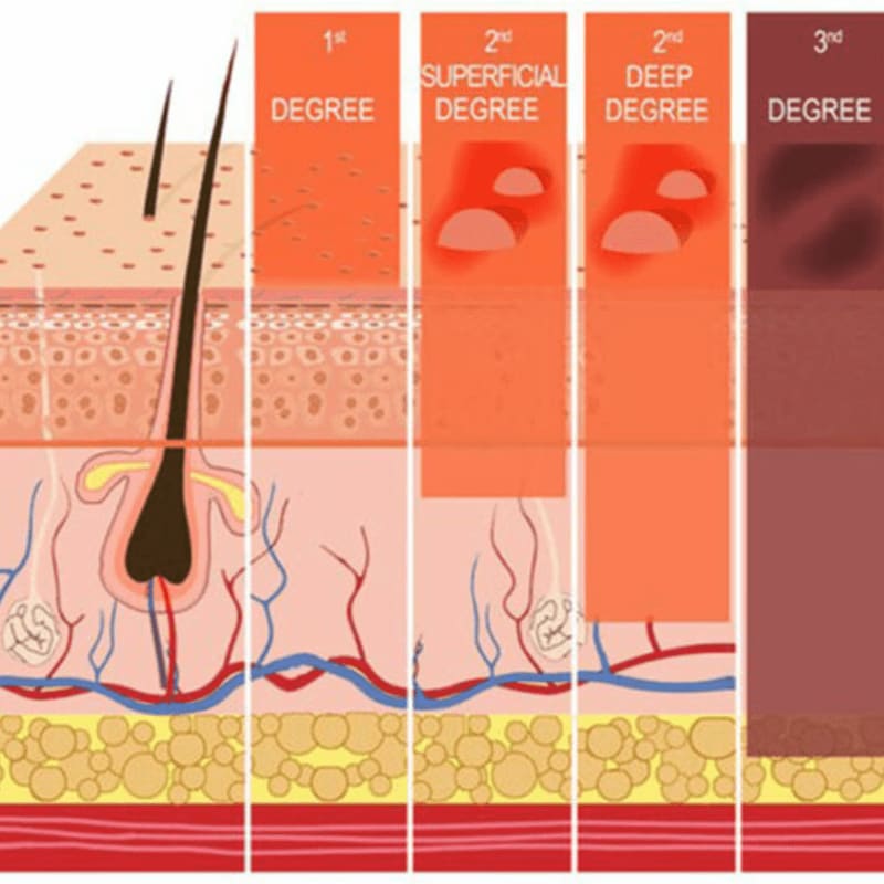 A cross-section of skin in the foreground illustrates different degrees of burns, with the background showing the progression of damage through skin layers.