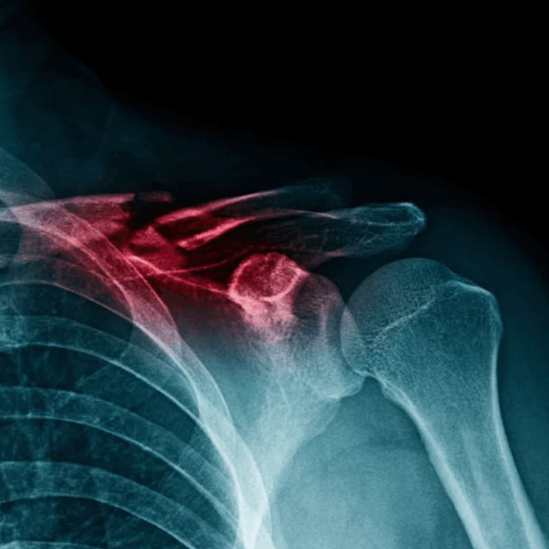 A red highlighted area of pain is centered on the shoulder joint and collarbone against a blue-toned X-ray of the ribs and upper arm.