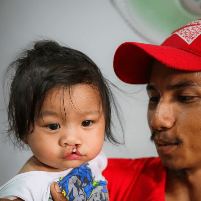 A man in a red cap holds a young child with a cleft lip against a plain, light-colored background.