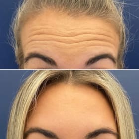 20 Units of Botox, Professionally Administered item