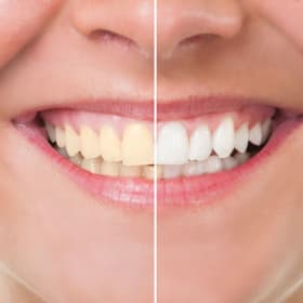ZOOM TEETH WHITENING $600 VALUE DONATED BY DR. DANI B. item