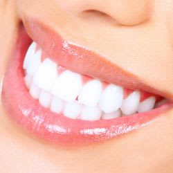 606 - Teeth Whitening Treatment item