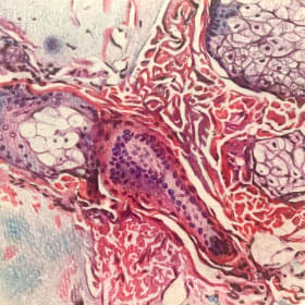 Cancer Tissue Slide (6.5" x 6.5" Original) item