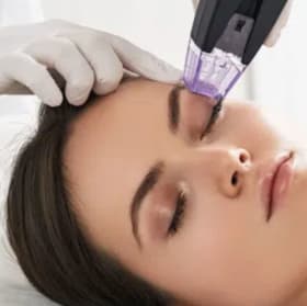 ✨ Radiance Revival: Microneedling Treatment item