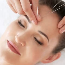 60-Minute Acupuncture Session at Oakville Wellness Clinic item