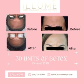 30 units of Botox item