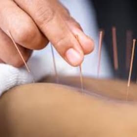 Acupuncture Session item