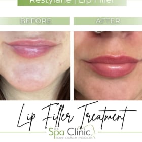 Lip Filler Treatment item