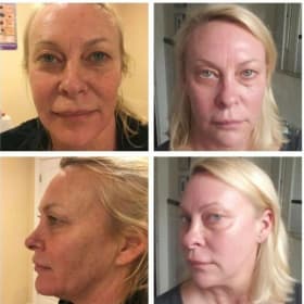 Photo of Pearl City Med Spa - Full Facial Resurfacing Treatment