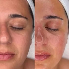 Hydrafacial Treatment item