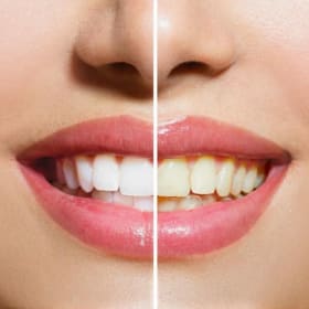 Photo of Whitening Kit